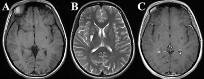 A Chinese Family With Adult-Onset Leigh-Like Syndrome Caused by the Heteroplasmic m.10191T>C Mutation in the Mitochondrial MTND3 Gene